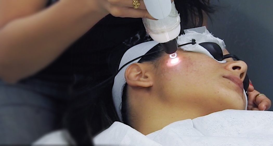 Q-Switch Laser Treatment at About Face, Mumbai | Review