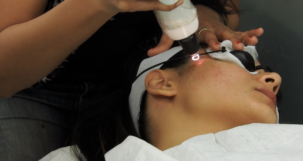 Q-Switch Laser Treatment at About Face, Mumbai | Review